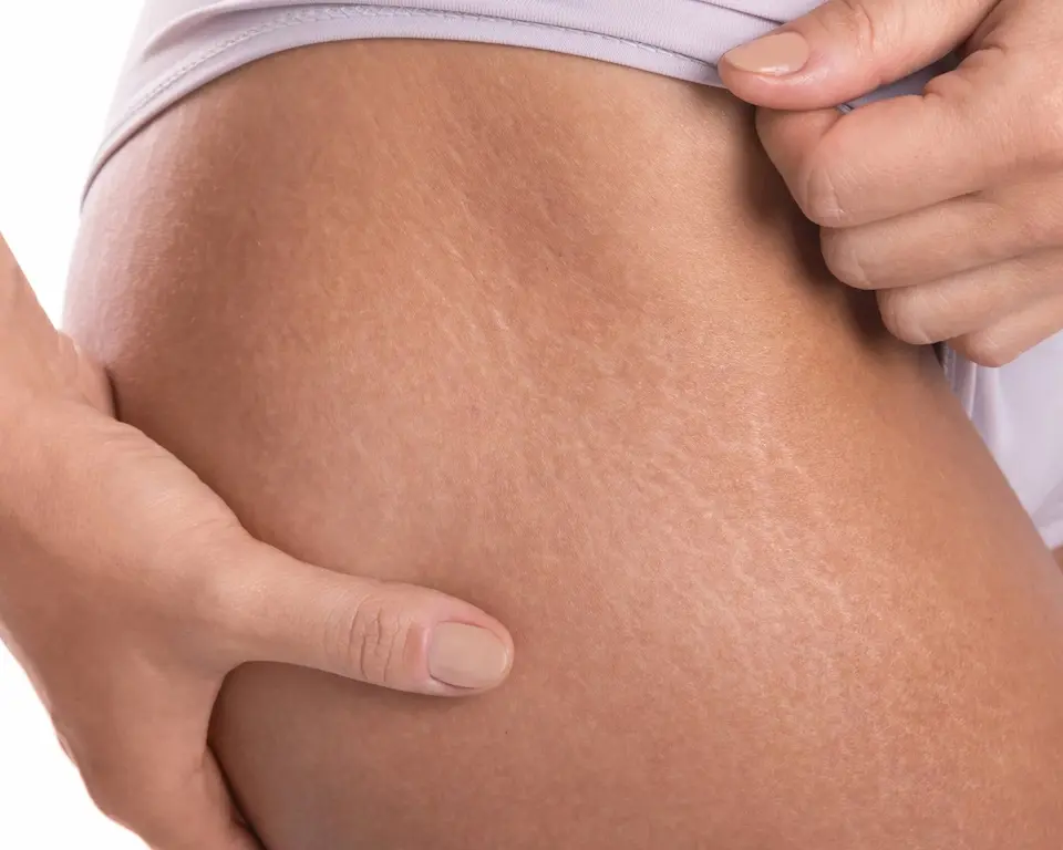 Stretch Mark Removal in Dubai